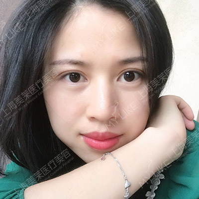 做完自体脂肪隆胸的手感好不好呢