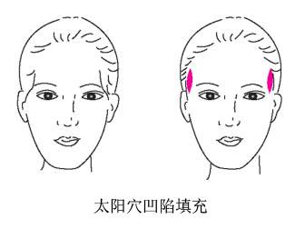 上海做激光去色斑大概多少钱