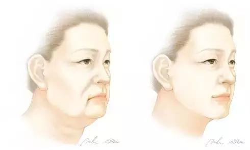 做进行一次激光脱毛需要多少钱呢