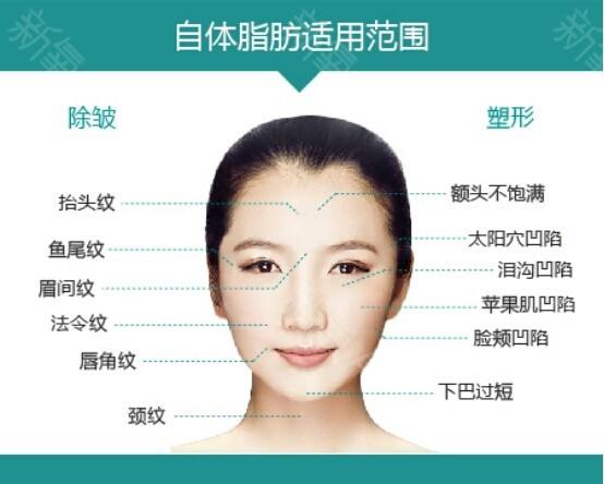 上海做假体垫下巴到底多久才能消肿呢