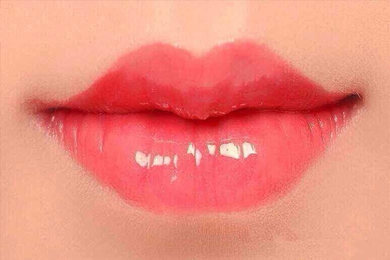 美莱医生讲解艾薇儿玻尿酸打造美丽心形脸