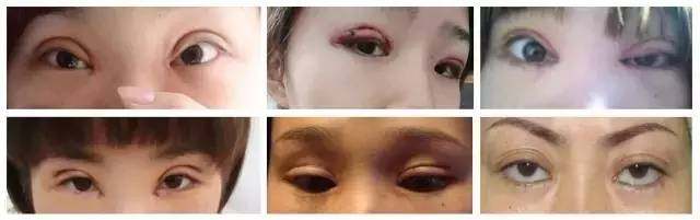 上海哪个医院做腿部吸脂效果好