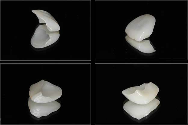 内双做双眼皮效果怎么样？好不好