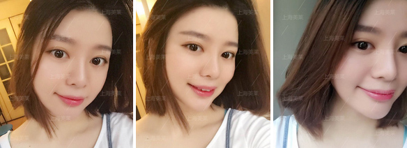 上海注射瘦脸针效果怎么样