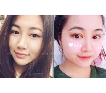 美莱举办隆鼻修复整形高峰论坛会