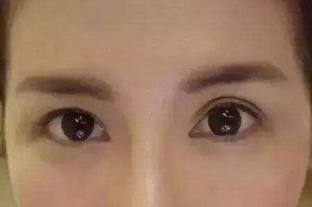 上海玻尿酸隆鼻哪家医院效果好