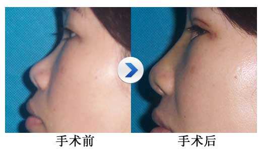 上海玻尿酸隆鼻哪家医院效果好