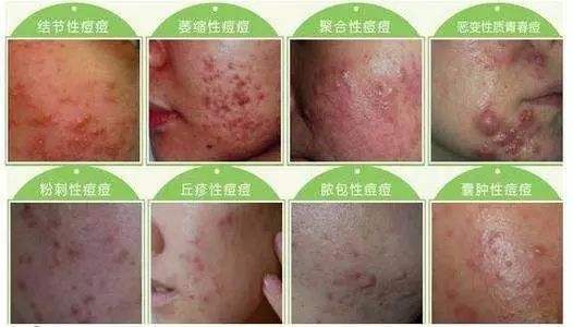 上海做做腹部抽脂减肥会不会有什么副作用