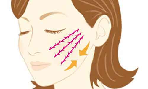 美莱医院分享乔雅登玻尿酸案例