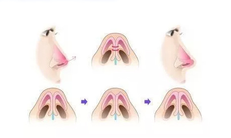 上海玻尿酸隆鼻需要打多少支玻尿酸