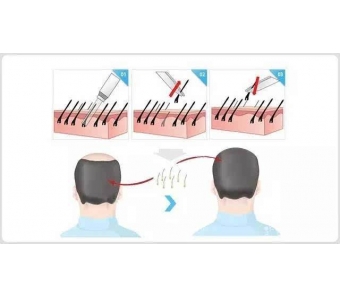 超皮秒激光治疗色斑的效果怎么样