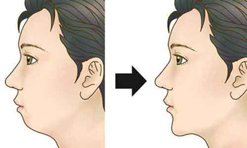 上海注射玻尿酸下巴后多久才能消肿