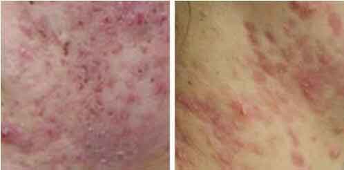 十几岁脸上就长了很多雀斑怎么办