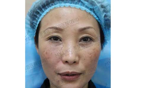 上海现在做全身激光脱毛的价格是多少