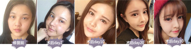 上海做开眼角手术后多久才能拆线恢复自然