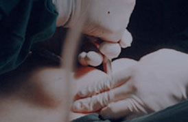 发际线上移怎么改善,上海美莱植发来帮你