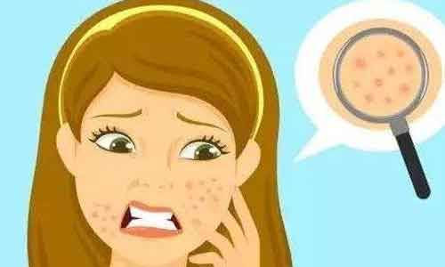 激光祛斑术后该如何做好护理工作