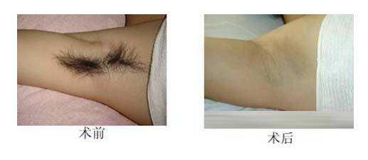 激光祛斑术后该如何做好护理工作