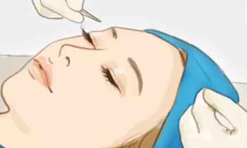 上海做激光祛斑以后容易反黑吗