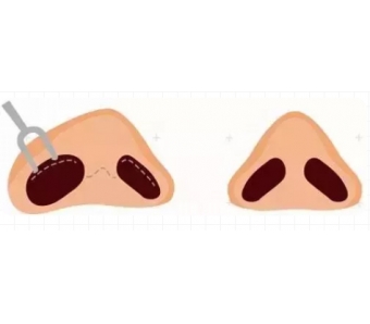 注射玻尿酸丰下巴会不会显得脸部很僵硬