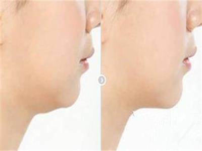 自体脂肪丰胸后能按摩胸部吗