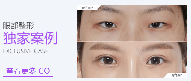 上海做自体脂肪隆胸多久恢复正常