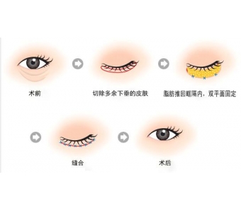 上海做激光脱毛价格贵不贵