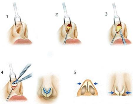 上海做自体脂肪丰胸多少钱啊