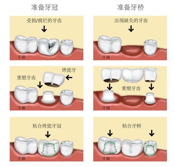 上海做自体软骨隆鼻整形需要多少钱
