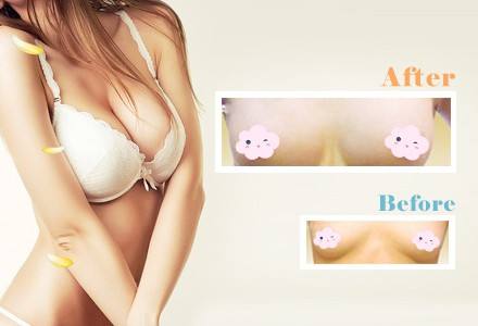 上海注射玻尿酸丰唇后嘴巴有点肿怎么办