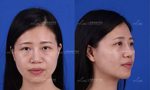 上海什么医院打水光针效果好