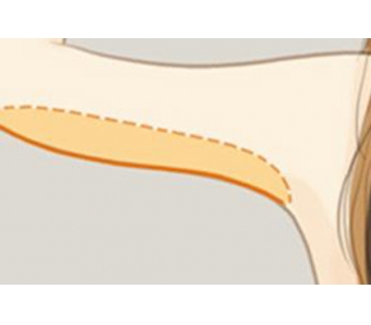 上海做假体隆鼻整形手术价格贵不贵