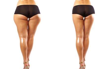 大腿吸脂后多久能运动，恢复有影响吗