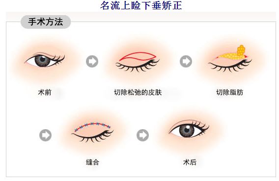 上海割双眼皮有什么危害，术后怎么护理呢