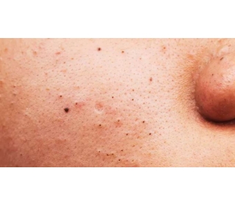 上海假体隆鼻会不会变形,怎么做效果才好