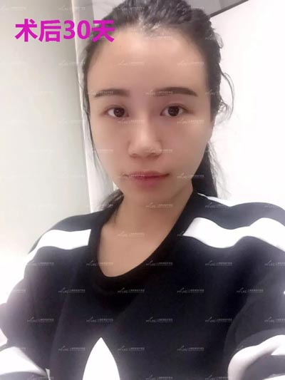 上海祛眼袋手术多久恢复自然,如何促进恢复