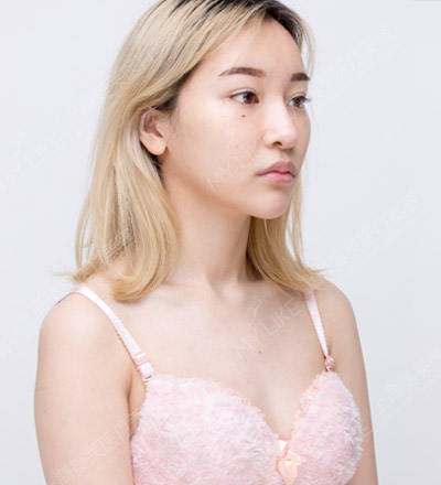 上海祛眼袋手术多久恢复自然,如何促进恢复