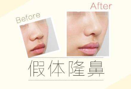 上海祛眼袋手术多久恢复自然,如何促进恢复