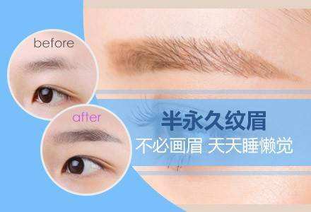 上海韩式双眼皮多久能消肿,多久会恢复自然