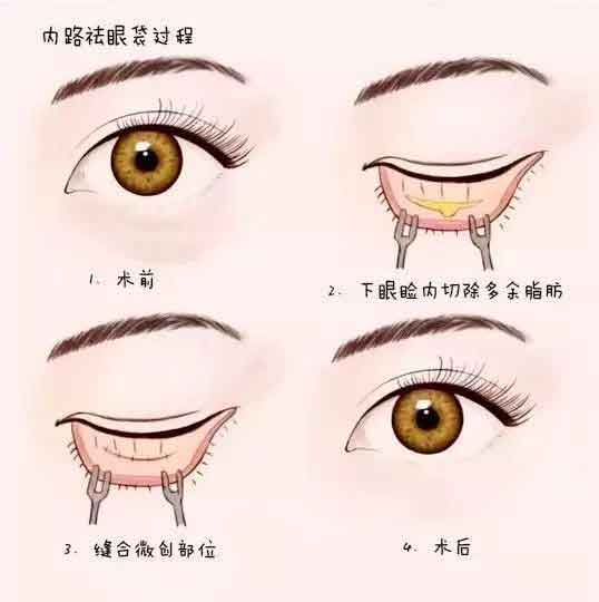 自体脂肪填充面部安全吗