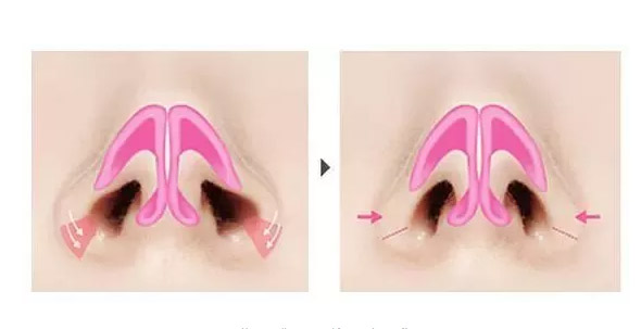 面部打玻尿酸的副作用有吗,应该怎么办