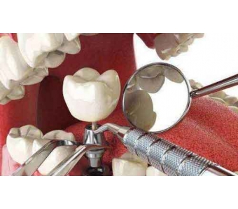 上海假体垫下巴几天拆线,恢复时间需要多久