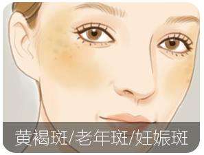 上海自体脂肪丰苹果肌多少钱,贵吗