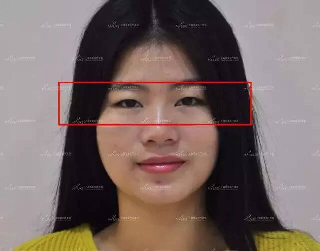 上海打完水光针为什么不能洗脸,术后如何护理