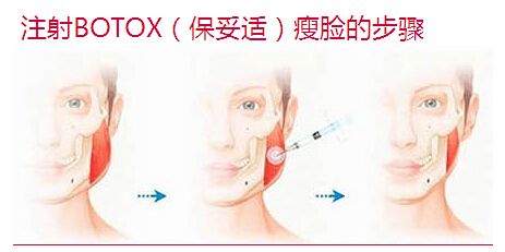 上海玻尿酸丰唇价格是多少,会很贵吗