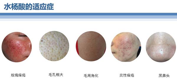 什么是激光脱毛，上海激光脱毛效果好吗