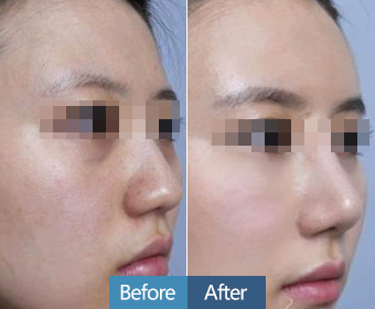 上海韩式双眼皮效果怎么样，术后需要住院吗