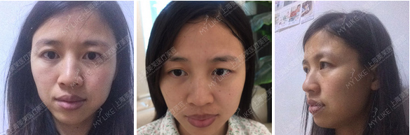 上海吸脂瘦脸有后遗症吗,多久可以洗脸呢