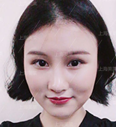 上海玻尿酸去法令纹多少钱,效果真的好吗