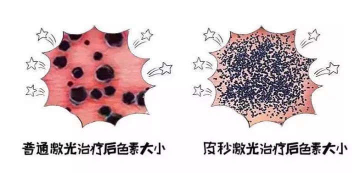 上海治疗上睑下垂多少钱，价格贵吗